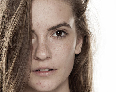 ACNE - Mechanisms & Myths