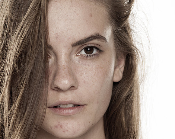 ACNE - Mechanisms & Myths
