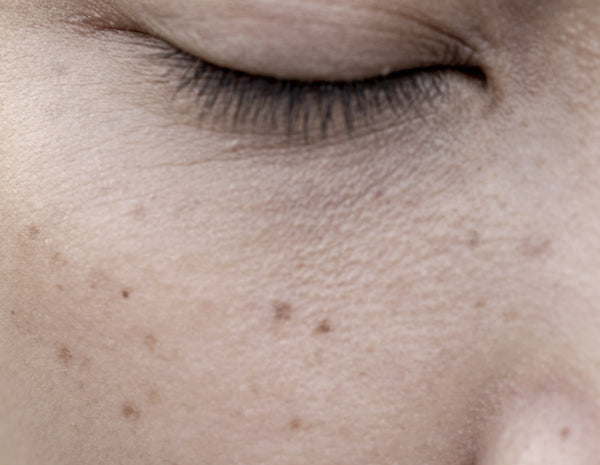 HYPERPIGMENTATION - Causes and 'cures'