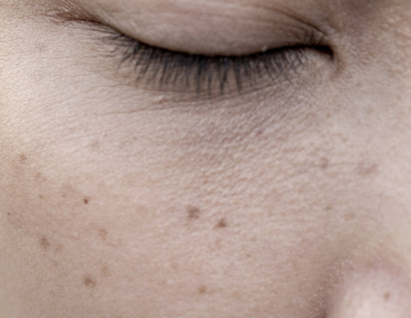 Hyperpigmentation: Causes, Treatment & How to Fade It Fast | Dermalist