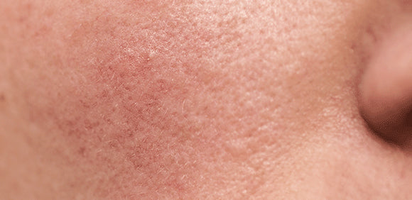 Rosacea: Causes, Triggers & Skincare Tips to Calm Redness | Dermalist